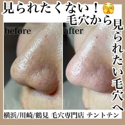 毛穴きれい！毛穴洗浄コース