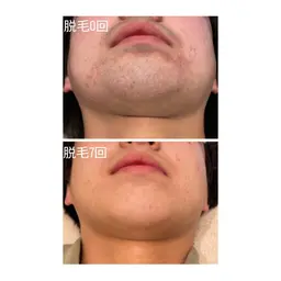 郡山最安値❣️メンズ髭脱毛/目から下首まで👀