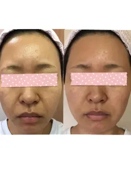 【シワにお悩みの方へ】光フェイシャルすっぴん来店でお値打ち