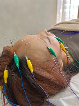 美容鍼（ご新規様限定）