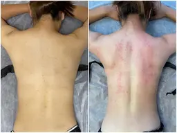 スライドカッピング　セル・筋膜リリース痩身　45分上半身ヒートマット付き