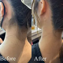 👶🏻12月限定うなじ脱毛👶🏻