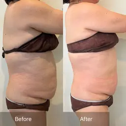 初回最強痩身レモン🍋10cc