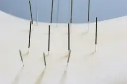 中国鍼の鍼施術4000円（1つの疾患のみ）