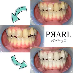 お得✨【口コミ必須】【初回お試し体験⭐︎】プレミアムホワイトニング¥3,700⇨¥1,000！！初回2トーンアップ多数✨