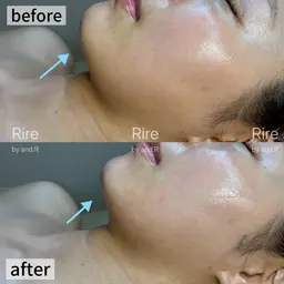 【緩んだ筋肉をググッと引き締め☆】リフトアップフェイシャル《プレミアム》