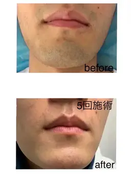 メンズ　ご新規様一回限り　髭脱毛　顔半分　光脱毛