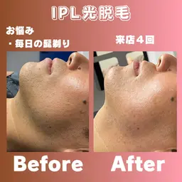 肌綺麗にメンズ髭脱毛★今年こそ髭剃り卒業👋熟練プロにしか出来ない見極め脱毛。適切なレベルで痛みが無いのに効果抜群