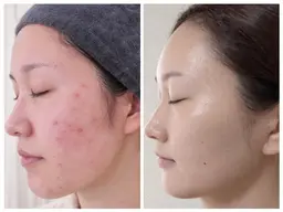 【ニキビ肌3ヶ月プログラム】 モニター価格 (都度払い分割OK!)