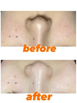 モニター価格　毛穴ケア