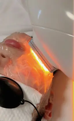 夏向け美肌脱毛コース（顔）