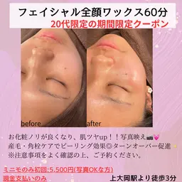 20代女性限定⚠️フェイシャル全顔ワックス✨産毛や角質ケアができピーリング効果◎お化粧ノリ・ツヤupで写真映え💖