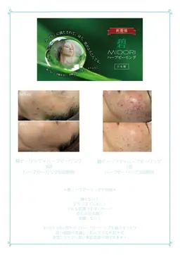 ハーブピーリング🌿5回コースモニター価格❣️