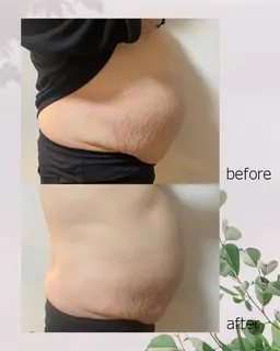 気になるお腹or太ももに◎『レットショットで溶解してスッキリ』全身リンパ付¥25000