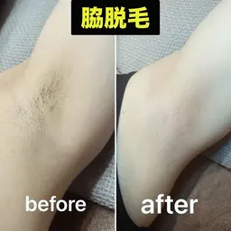両脇ワックス脱毛‼️