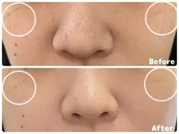 人気No.1✨60分コース毛穴洗浄＋フェイシャルマッサージ＋ヘッドマッサージ＋美白パック付き