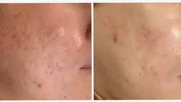 【ニキビケア/凹凸】赤み改善ハーブピーリング/ポレーション導入コース¥5500✨