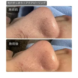 【毛穴詰まり】毛穴洗浄+ドライヘッドスパデコルテコース60分¥6800