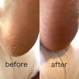 足裏角質ケア【保湿パック付】