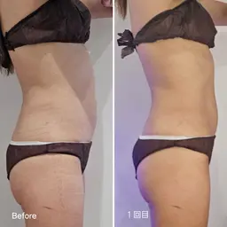 【話題の脂肪痩身マシン】✨LUMIX LIPOCOOL✨2カップ