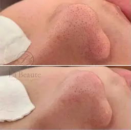 毛穴エクストラクション(炭酸ヘッドマッサージ付き)