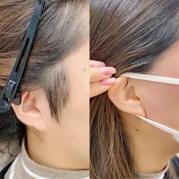 スッキリ垢抜け🤩うなじ&もみあげワックス脱毛　¥5000