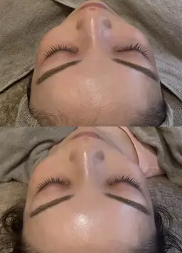 人気No2✨【黒ずみ.毛穴詰まり👃スッキリ】毛穴洗浄🌪️+電気美容鍼⭐️エレクトロポレーション導入付き学割◎