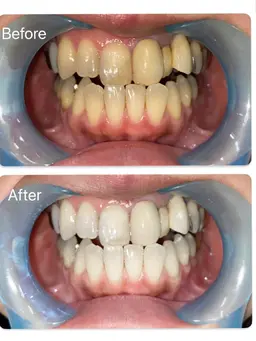 ご新規様限定LEDライト10分×2回照射コース