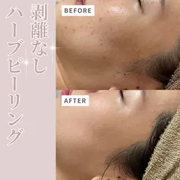 【ミニモ学割💖】剥離なし✨ハーブピーリング🌿🇰🇷