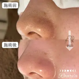 【毛穴美人コース】毛穴エクストラクションプロ＋オイルトリートメントマッサージ(デコルテ、顔、頭)＋生パック+整肌お仕上げ