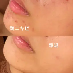 【土日クーポン💖❕】11.12日限定✨肌トラブル総合コース（ピーリング&パック）ヘッドマッサージ付🕯♡♡