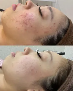 【角栓・ブラックヘッド・ニキビ跡・くすみ】🌸美容クリニックで話題🌸白玉スノーピール😲シワ・リフトアップも！