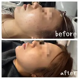 ✨OPEN記念✨【とにかくお肌を綺麗にしたい方💎】ラテスパ&針入りハーブピーリング剥離あり