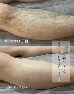 【男性】両足両腕まるごと脱毛🫧