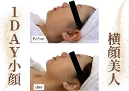 🔥小顔人気No,1【小顔造顔】針を使わない【脂肪コントロール剤】導入×小顔コルギ×石膏パック×デコルテマッサージ
