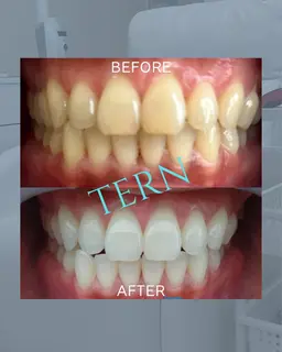 歯のセルフホワイトニング5分2照射