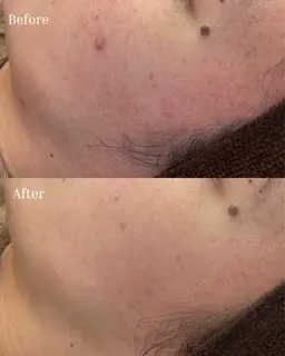 【人気No.1】ニキビ/赤み/毛穴に◎ 剥離なしハーブピーリング🌿通常価格¥17,000→¥11,000