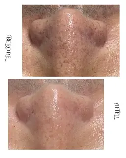 《ハリ｜陶器肌》艶肌ワックス＋ハーブピーリング