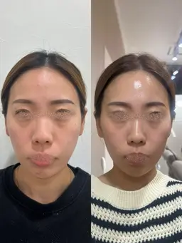 7日間で感動の変化！毛穴・肌荒れにお悩みの方🌟韓国ブランド "ICDインセルダム" スキンケアカウンセリング