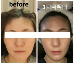 NEW【11月3名様限定】小顔矯正リフトフェイシャル