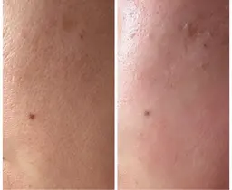 お顔全体ワックス脱毛で毛穴ケア♪潤艶美肌へ♪