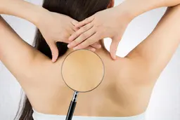 背中ニキビ＋背中脱毛＋シミ 集中ケア　【背中ニキビがある方必見】￥8800