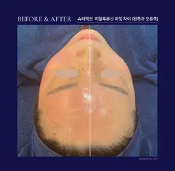 【シワ毛穴】最高級✨スーパージェクションフェイシャル（ナノチップ導入）