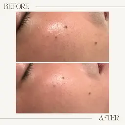 【半額モニター】🩷クイックトリートメント