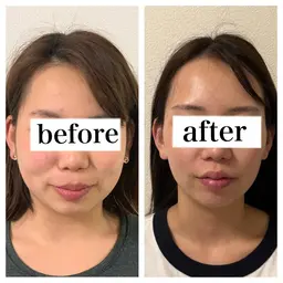 【1番人気最先端マシン💆♀️】1度で小顔!フェイスラインアップ!小顔矯正💆♀️×840ショット🔥
