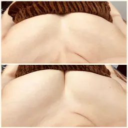 【まずはお試し】痛くない光豊胸、フラッシュバスト300ショットで本気の美乳ケア❤都内唯一のバスト専用機導入★