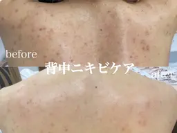 夏に向けて☀️背中　二の腕　お尻選べるハーブピーリング🌿22,000→8980