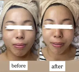 小顔トリートメント体験​〜​短時間で実感、肌が若々しく​〜​最新機#テラボーラー
