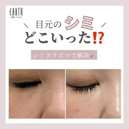 【最新シミ取り🪄＋プラズマシャワー🚿＋美容液導入】シミイボソバカス肝斑が気になる、ダウンタイムが出てもいい方◎