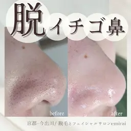 『毛穴の黒ずみにお悩みの方へ😔🍓』クリニック導入アリの機械で毛穴洗浄+美容液導入✨毛穴ケアハイドロスキン